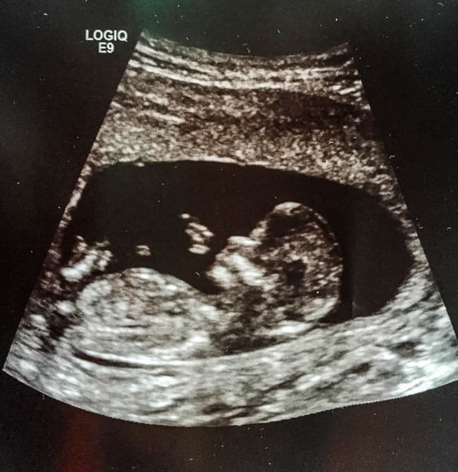 Ultrasound of baby at 12 weeks